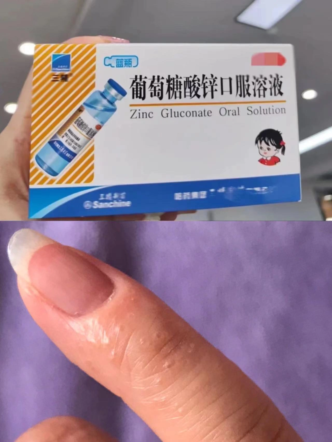 啥原理！？汗疱疹的征兆原来是这样的！