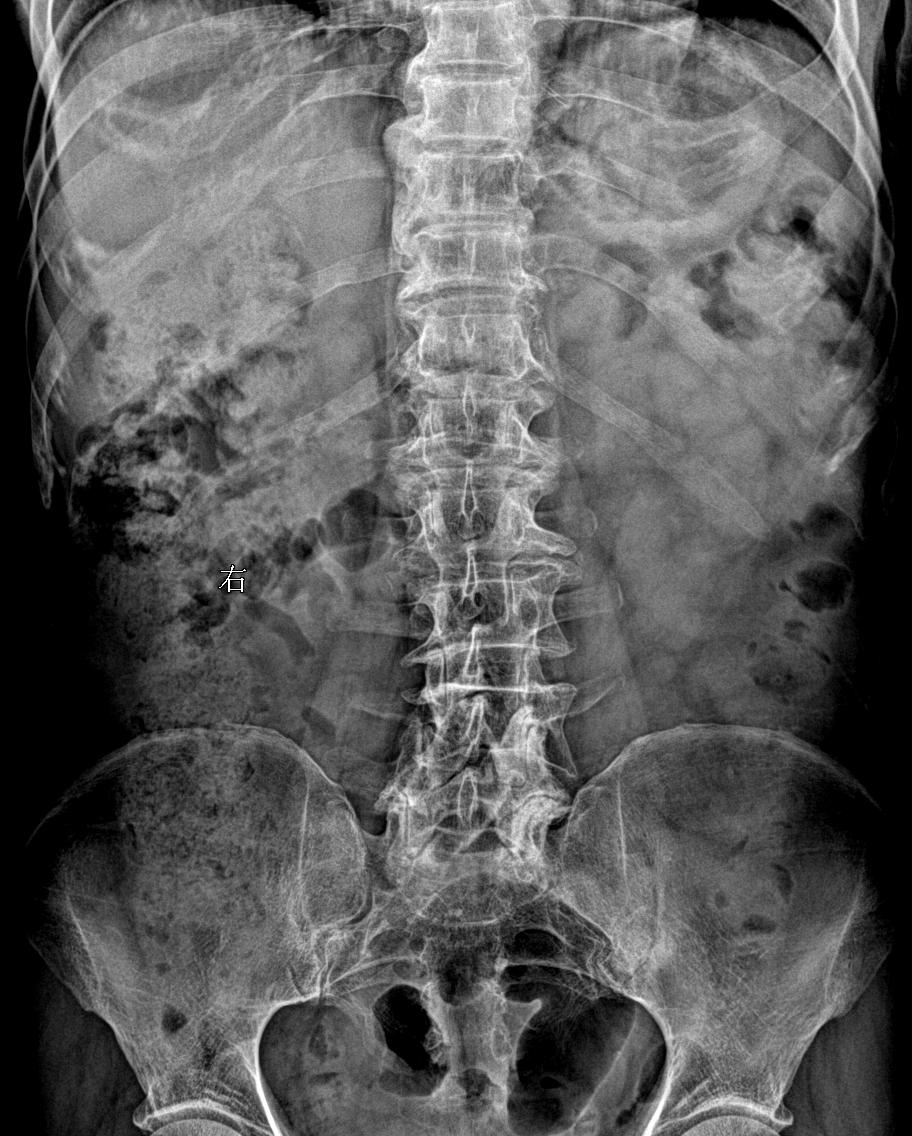腰椎疼痛，滑脱几度？
