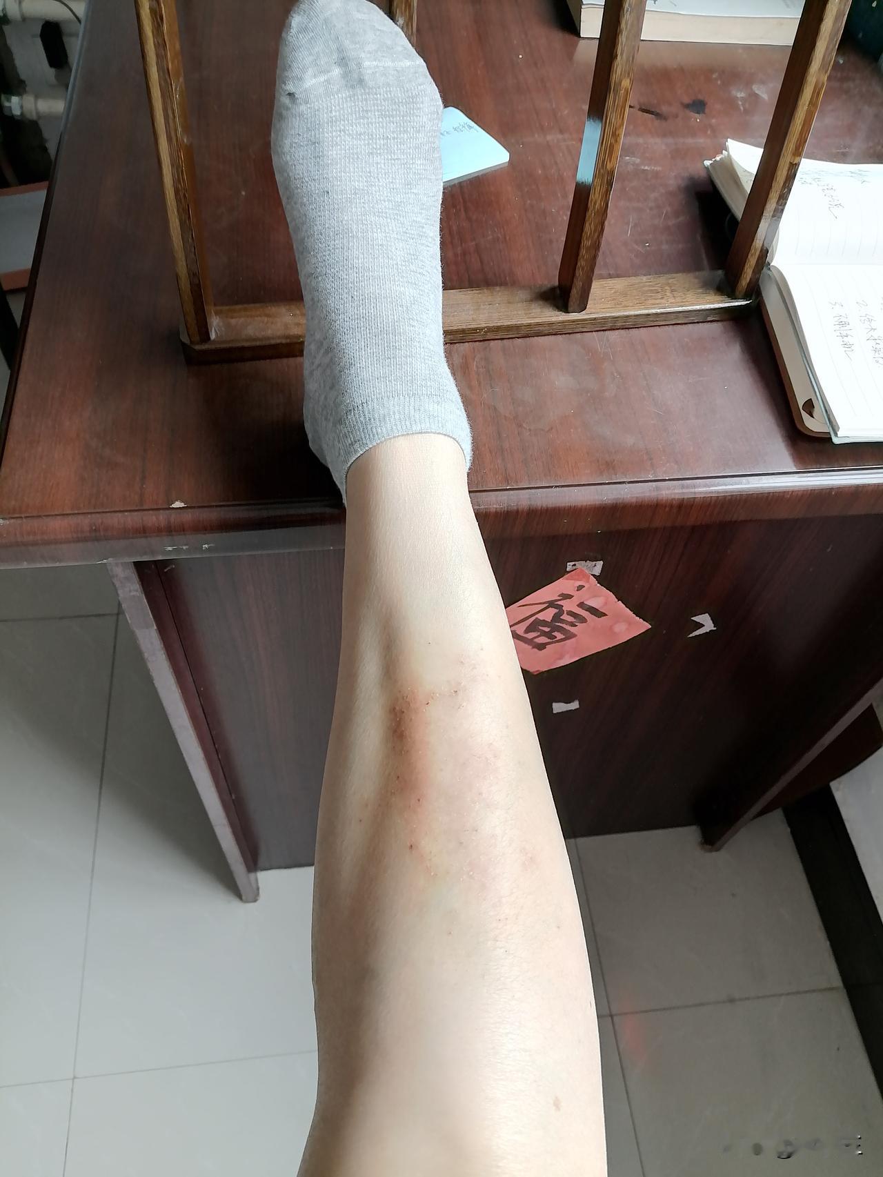 我的腿算是好了，一直在往好的方向发展。

之前，王医生不在诊所，出门了，她侄子给