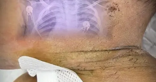 10个月大男婴被母亲扎数百针