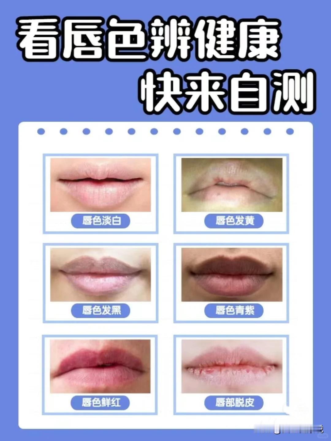 嘴唇干不要舔一舔，越舔越干，你要这样干。
如果你是嘴唇周围颜色变红，皮肤感觉发热