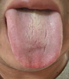 淡舌黄厚腻苔，虚实夹杂寒热错杂，疲软乏力该如何调治？






不少粉丝来咨询