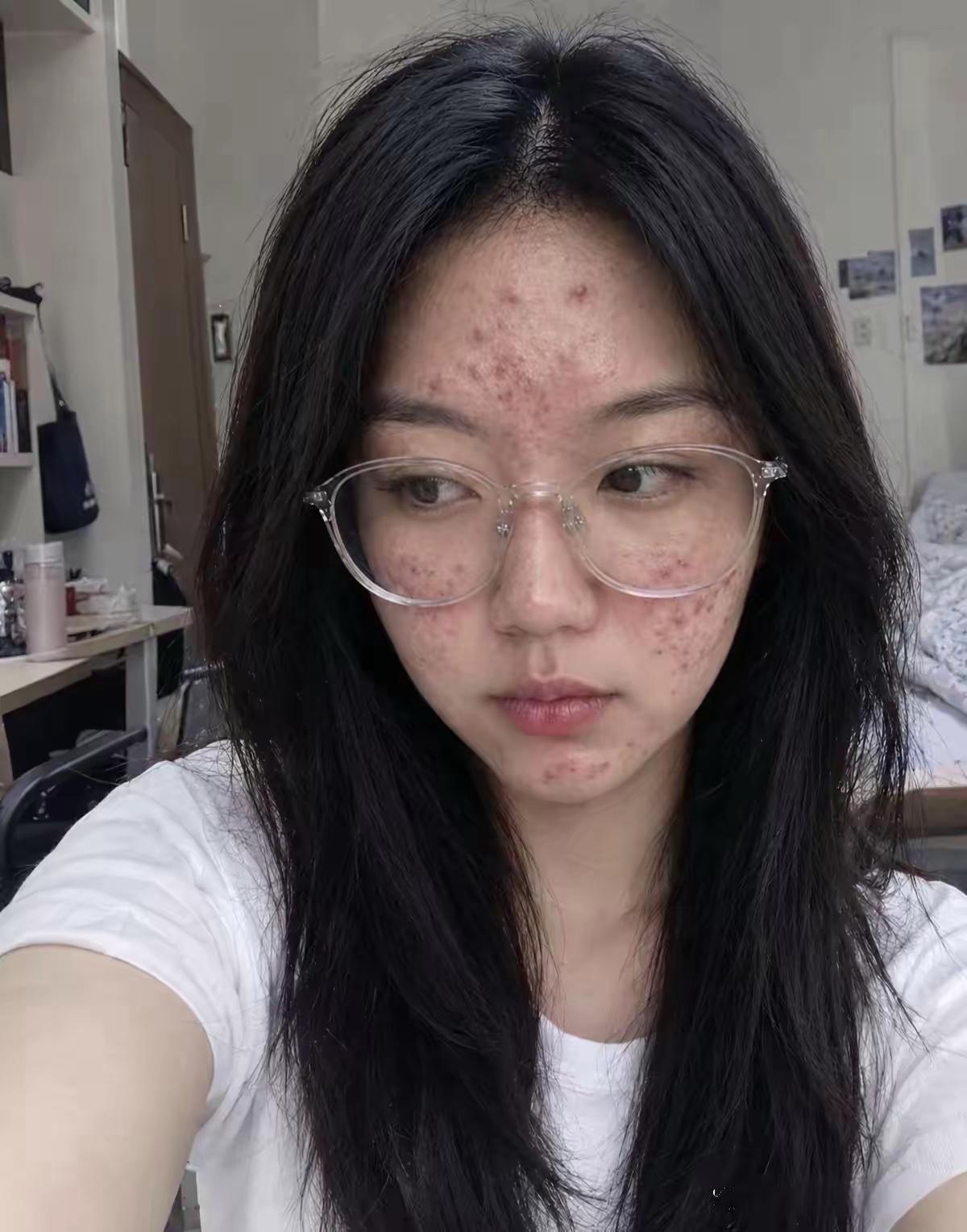 最近心情老不好了，你看看我的脸就知道咋回事了。

也不知道是季节的变化，还是吃啥