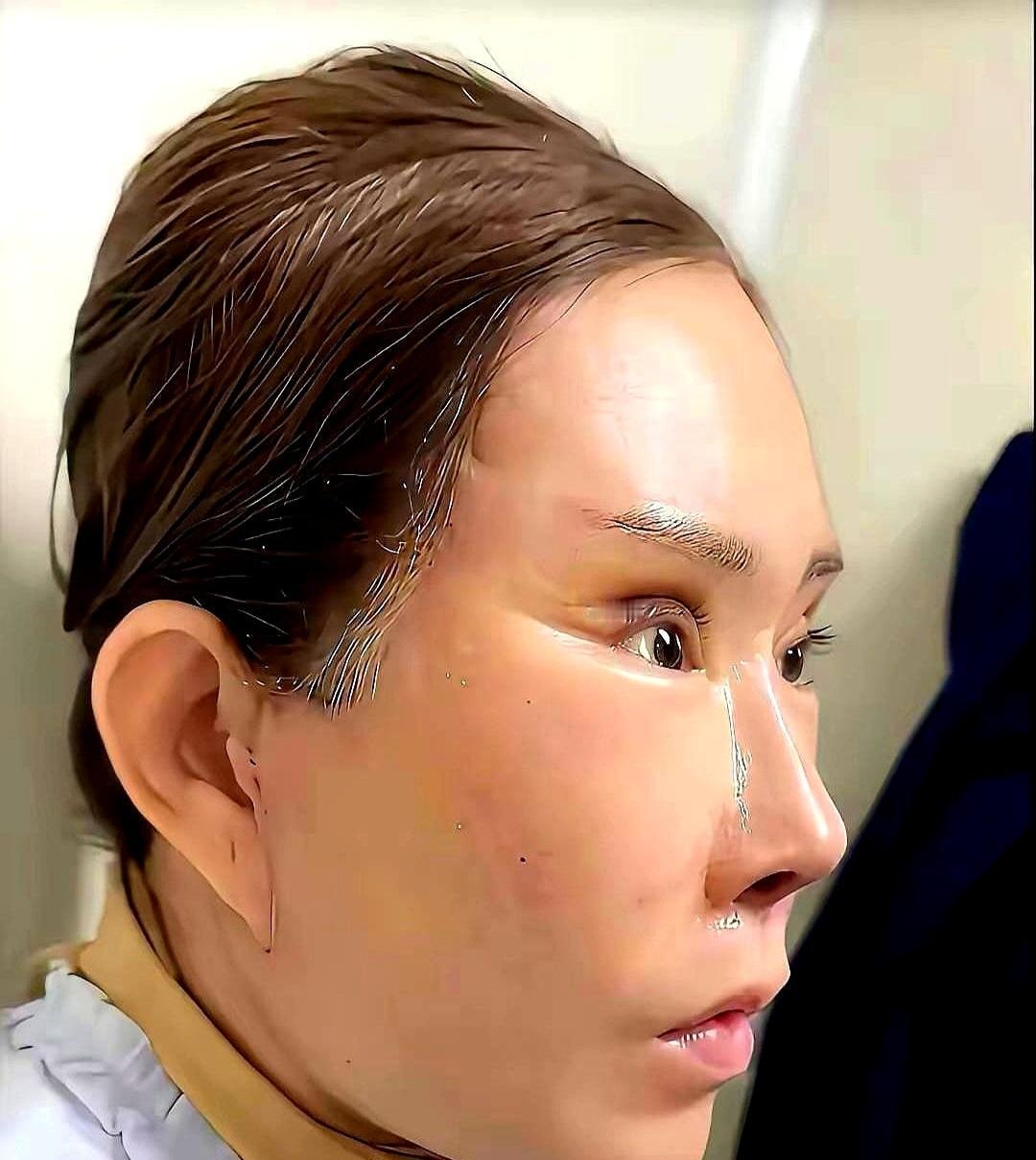 广西一位退休刘大妈为了在广场舞队里出风头，经不住闺蜜劝说去做了整容。