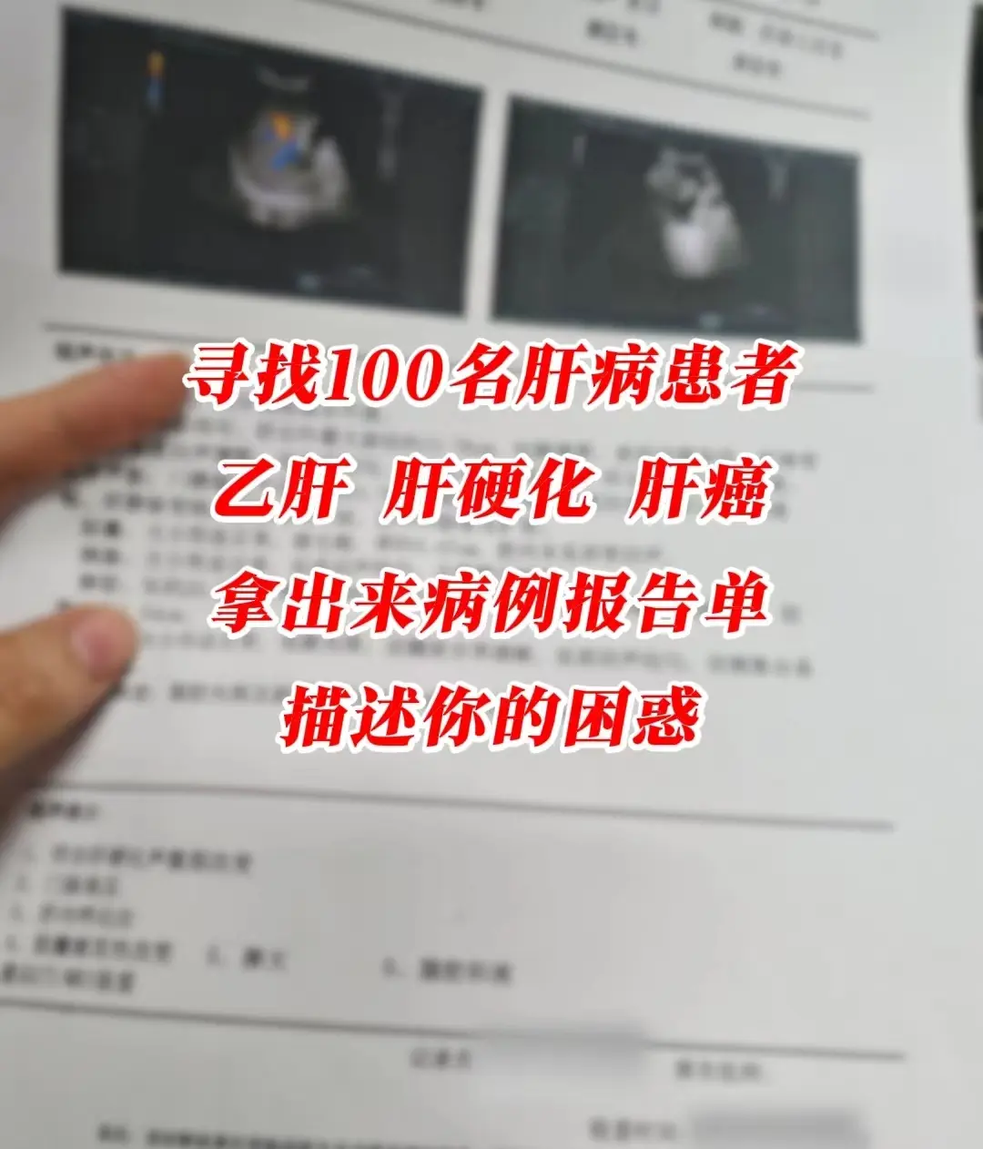 肝病 肝脏健康 干货分享 乙肝