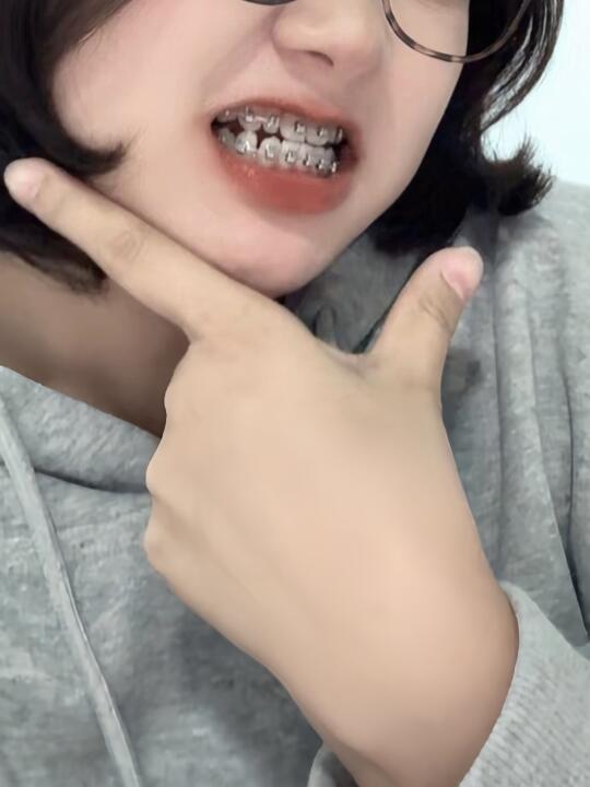 牛马也在武汉找公背主任正畸戴上1w钢牙咯