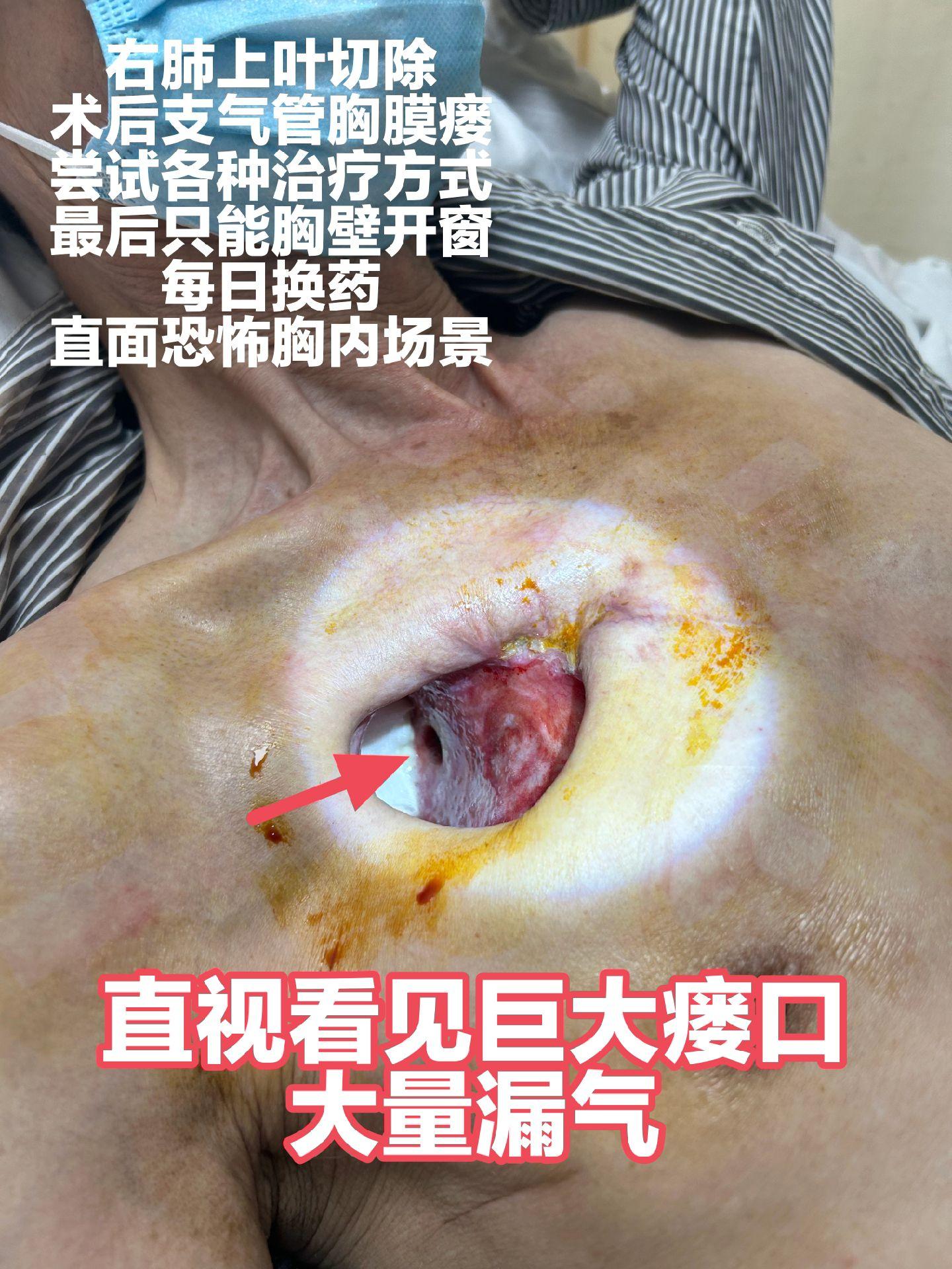 右肺上叶切除术后支气管胸膜瘘开窗分期治愈。右肺上叶切除术后，支气管胸膜瘘，右肺上叶支气管几乎完全敞开，巨大瘘口，只能开窗。家属每日换药，直面胸内恐怖场景。患者来七院求诊，无奈瘘口太大，网膜太薄，只能勉强闭合瘘口，今日二期关窗。
