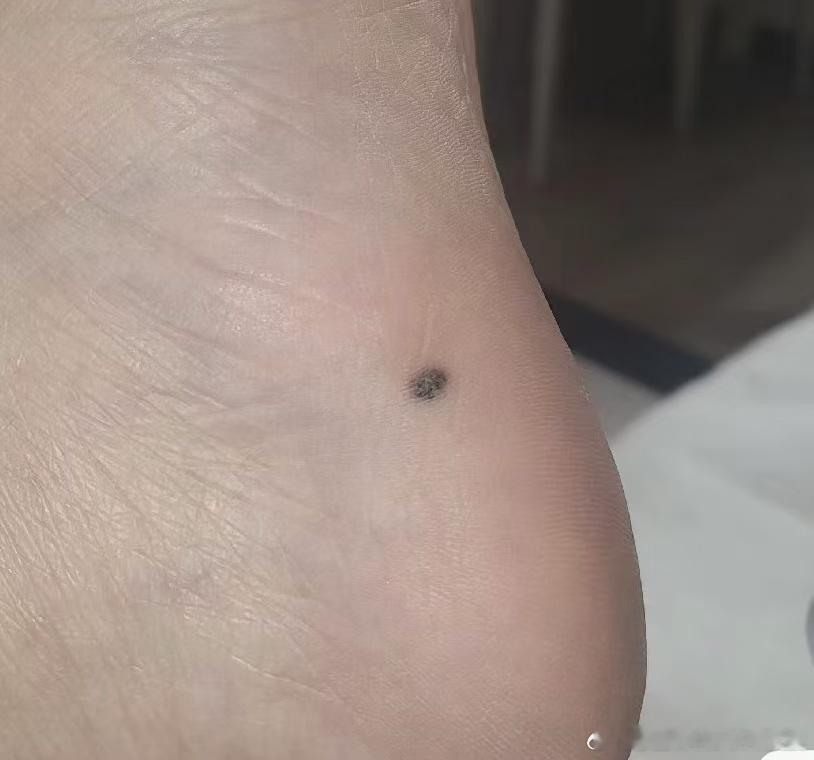 小红的脚底板长了一颗痣，最近发现痣有明显的变大，她问小美这颗痣是不是应该去掉？小