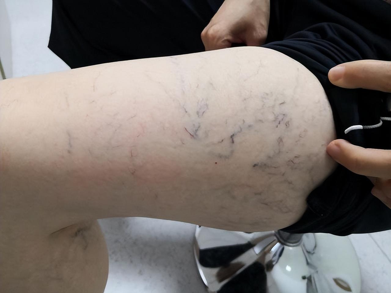 研究发现：一旦查出静脉曲张，这6件事就不要做了，别害了自己！

静脉曲张，很多人