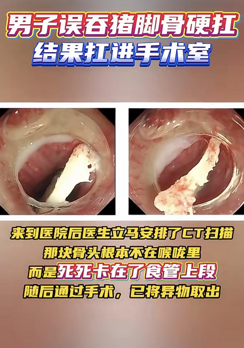 广东男子吃饭遭遇惊魂一刻!2厘米骨头卡食管，这个致命错误千万别犯
东莞的黄先生吃
