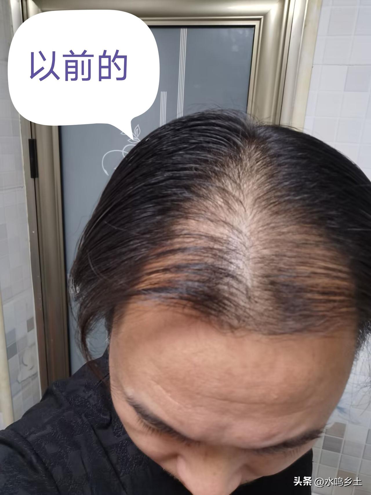 头发对于一个人的形象真的很重要，我以前也不会担心自己会脱发的问题，因为家里没有脱