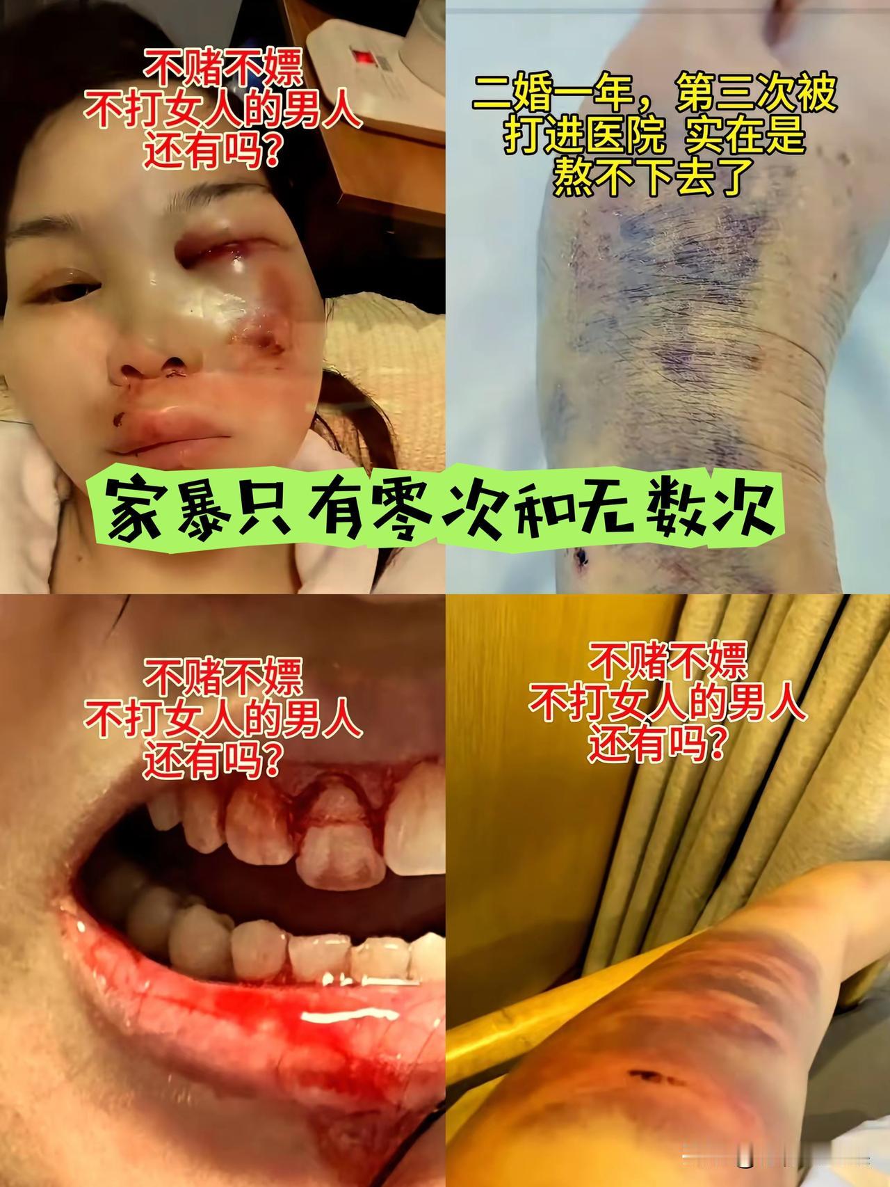 你们瞅瞅江苏这位女士的惨样，脸被打得鼻青脸肿，身上到处都是伤，二婚本来是想找个靠