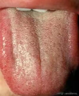 这舌头是肝郁不假，但是你疏肝未必好用[狗头][狗头][狗头]
粉丝反馈：口干，口