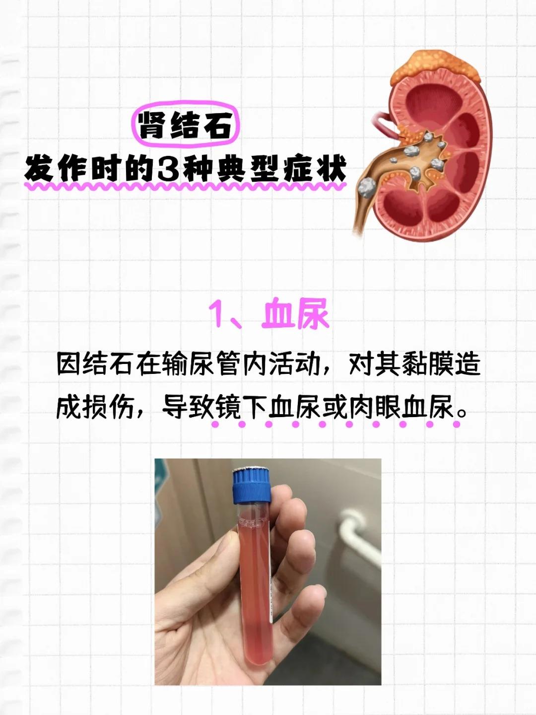 疼到打滚？肾结石发作的3大信号！