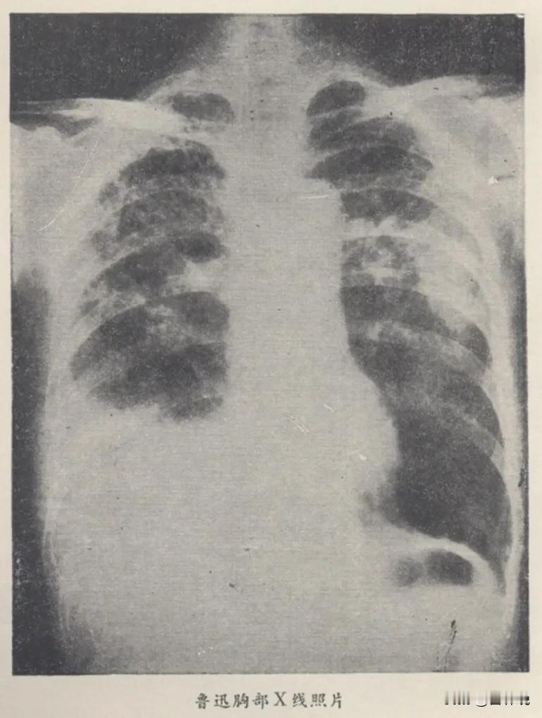 1936年年初，鲁迅病了。1月3日他在日记里写道：腋肩及肋均大痛。

第二天去医