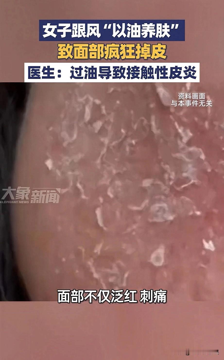 最近看到个揪心的新闻：一位女士跟风“以油养肤”，结果脸不仅泛红刺痛，还疯狂掉皮，