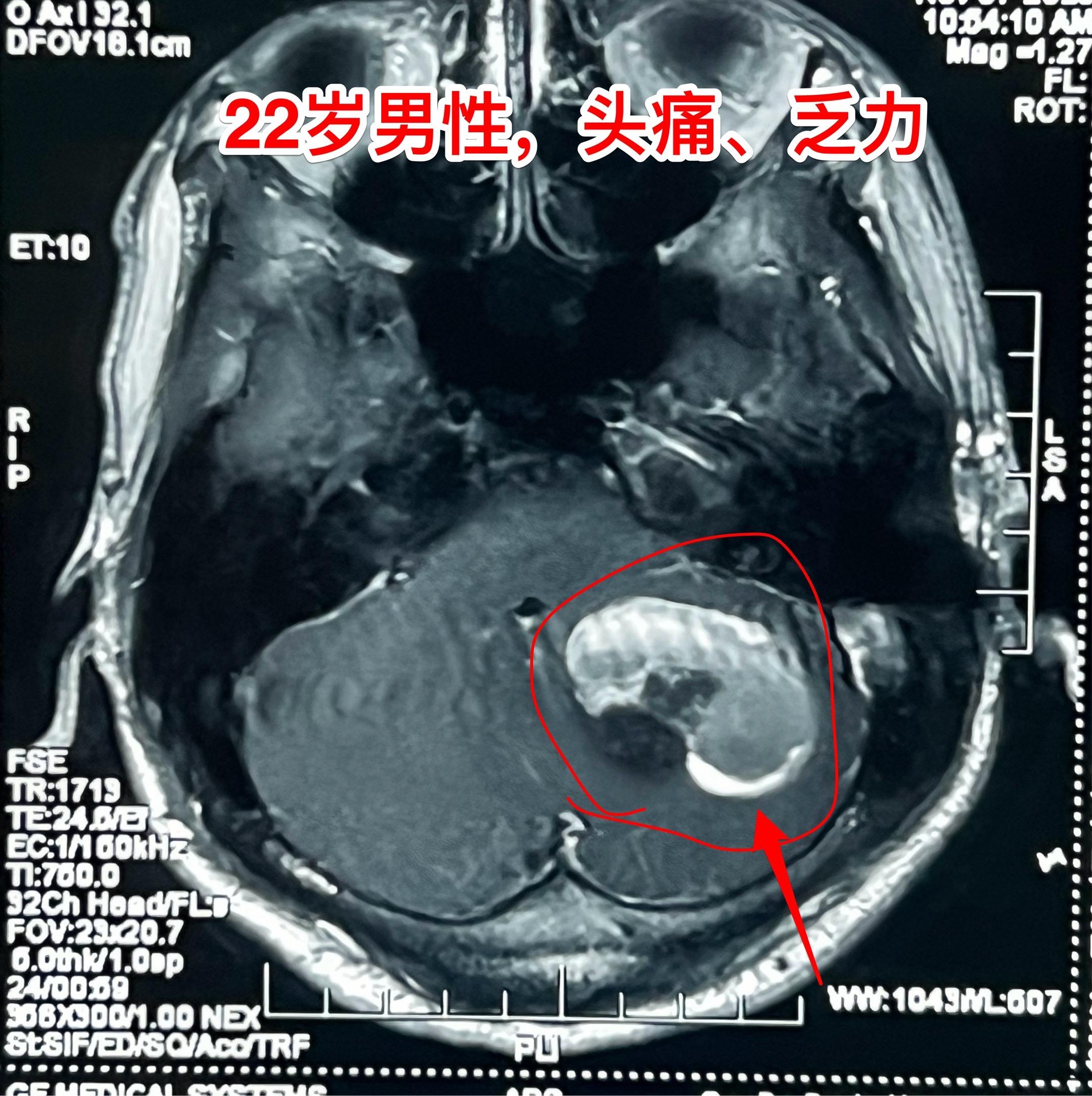 海绵状血管瘤出血。22岁辽宁省小伙子一周前突发头痛、乏力，一周之内几乎...