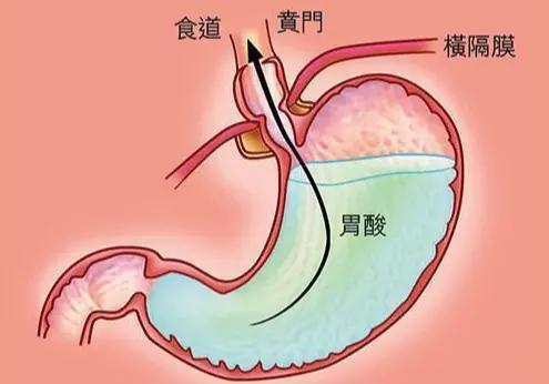 胃食管反流患者，几个注意事项　　今天和大家把胃食管反流病患者，日常生活中应该注意