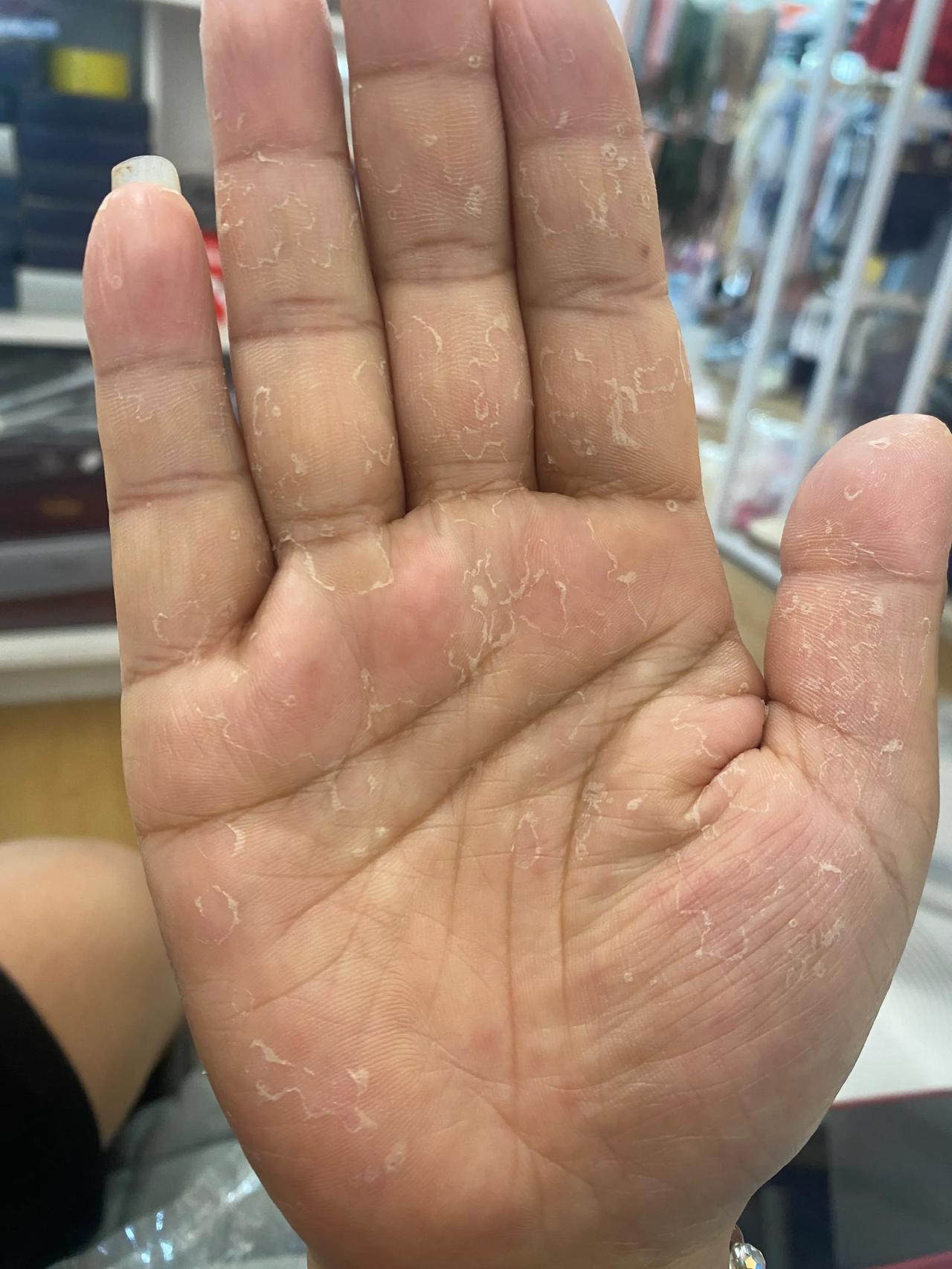 有没有同样的手，一到这个季节就脱皮，啥都不管摸？
