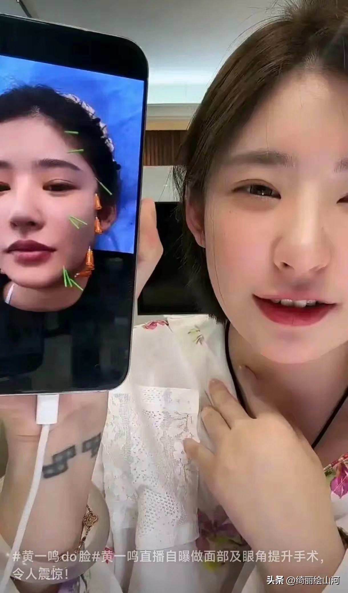 黄一鸣整容对比图曝光！自曝花10万动脸，网友：王思聪最自然前任 