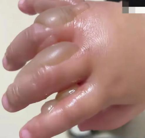 张纪中才9个月的小女儿手被保姆给烫的满手都是大水泡，隔着屏幕看都觉得手好痛。
