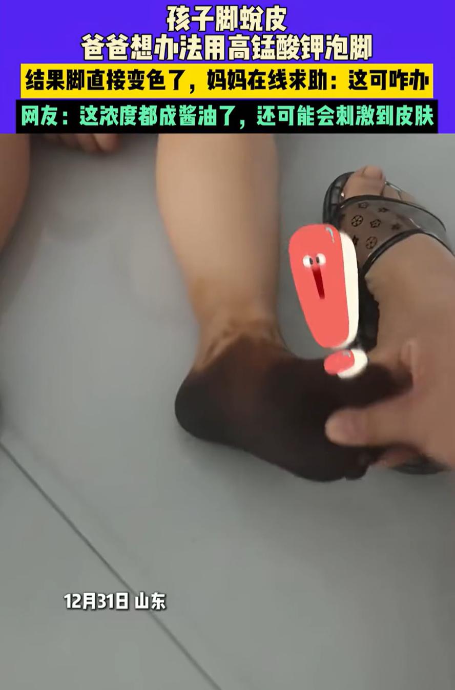 这下傻眼了！山东，一对夫妻发现孩子的脚蜕皮，爸爸想办法说可以用高锰酸钾泡脚，没想