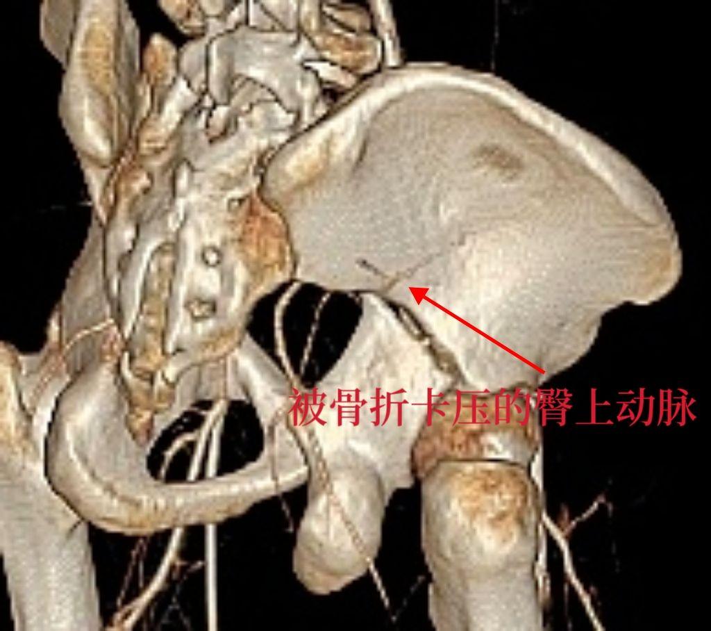 一个简单的T型骨折，术前CTA显示臀上动脉在骨折端卡压，虽然有充分的思...