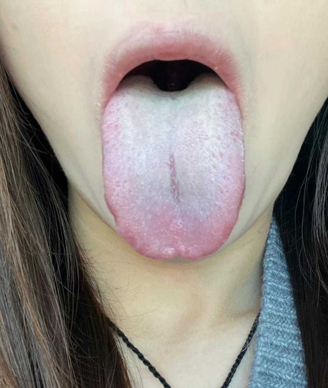 乱吃药的典型舌[发怒]，寒、热、湿，全找上门了！
天天说，天天说，你不随意服药好
