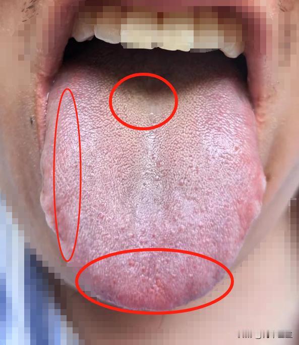 舌面看着很健康，其实问题大了去了，别等到不好回头，再来调理

主诉：尿频尿急，尿