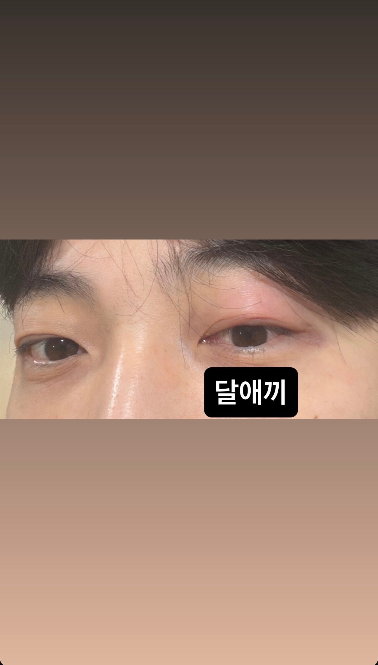 ［xlimi2t Ins story更新］260613 啊 😢“麦粒肿” 