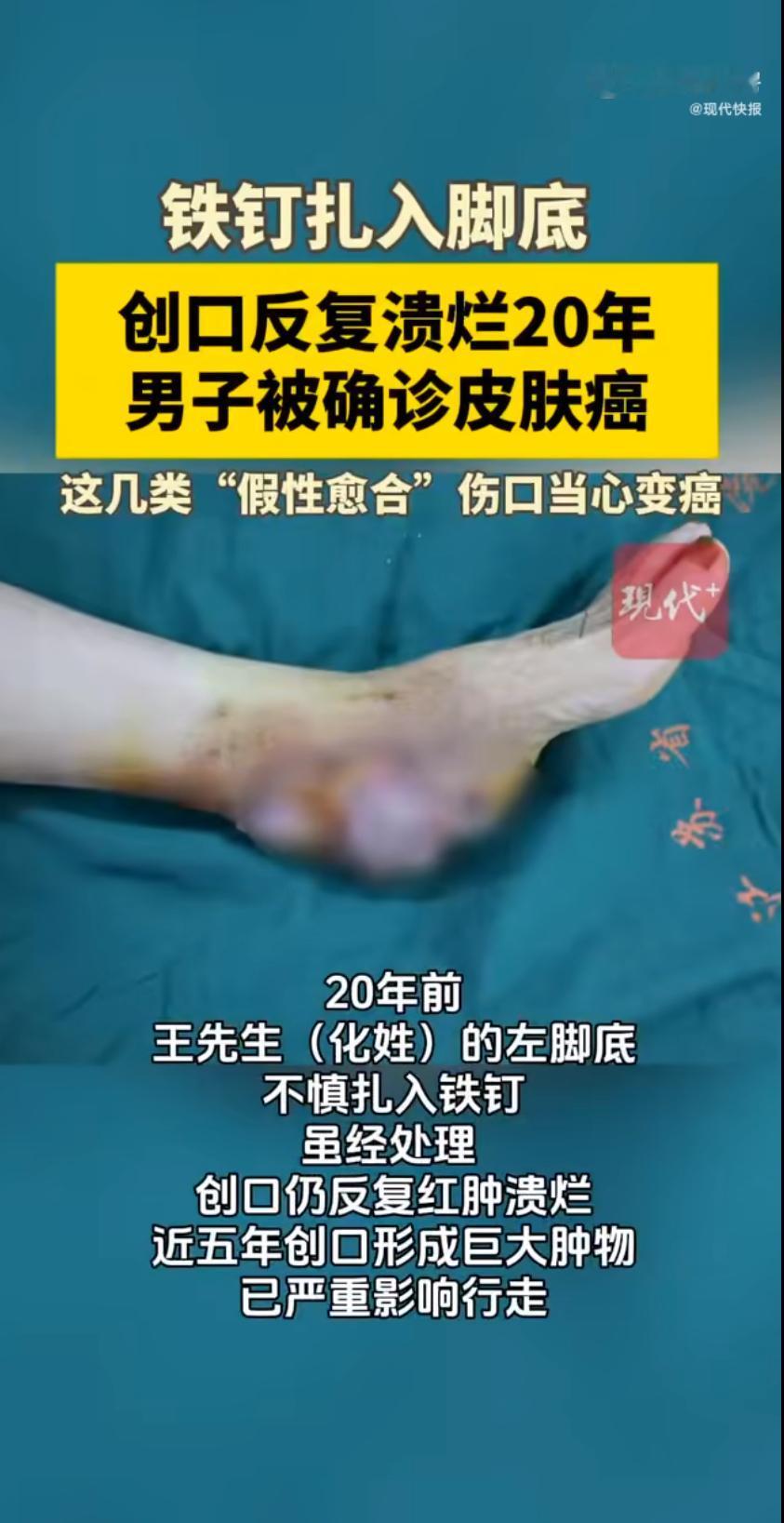 一则新闻让人心惊：一名男子20年前不慎被铁钉扎伤脚部，当时未彻底处理，伤口看似愈