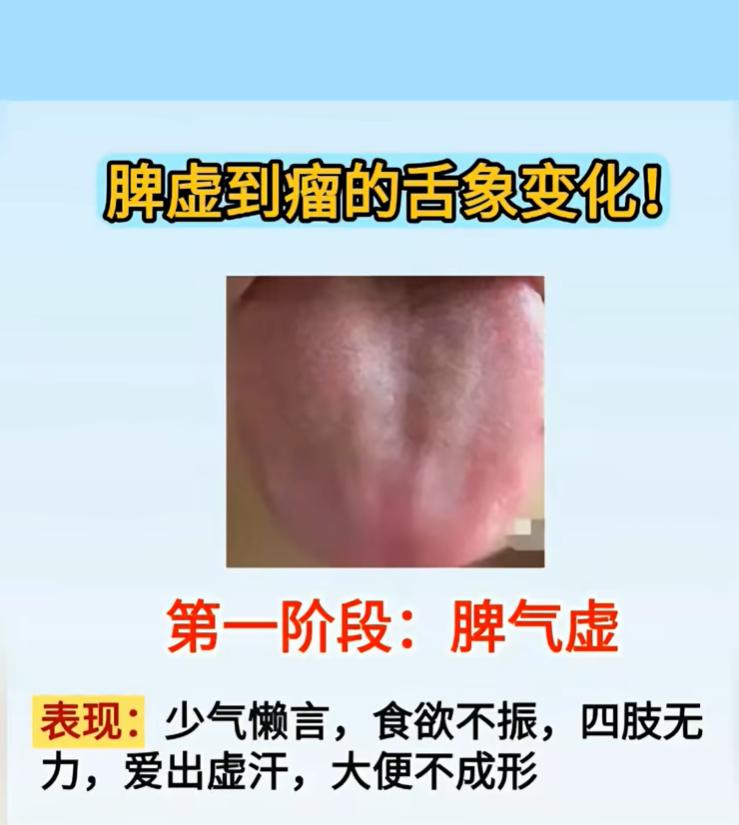 脾虚一步步发展的 7 个阶段，对照舌象看懂体质变化