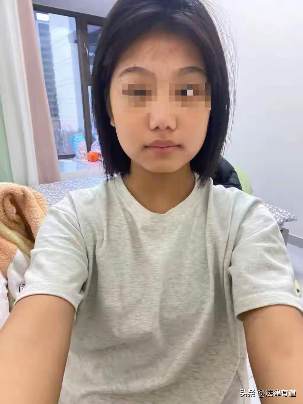 花季少女被诱骗“吸笑气”后惨遭90%烧伤：两嫌犯批捕，父亲两次割皮救女（澎湃新闻