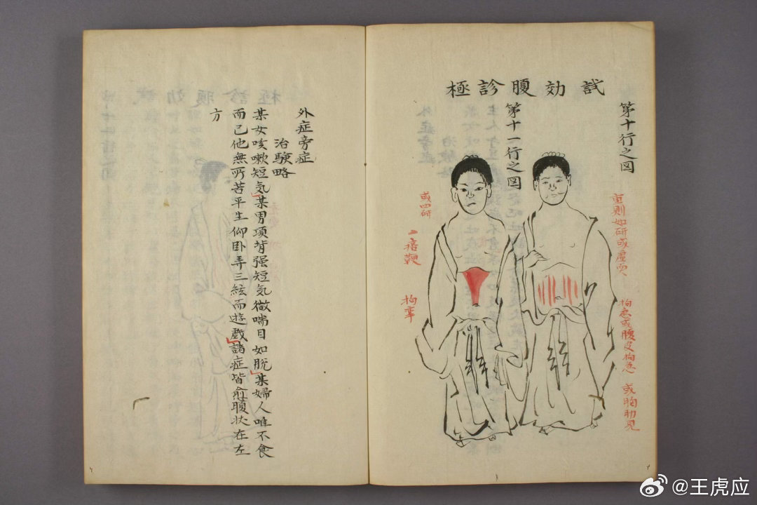 《诊极图说》是日本江户时期汉医濑丘长圭撰写的腹诊专著，全书分上下两卷，仅以手抄本