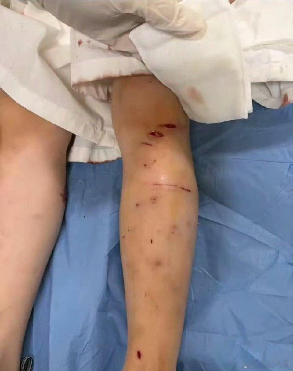 苏州遛狗不拴绳咬伤两名幼童，前两天刚看到一位女士被撕咬身亡，今天又看到这个消息，