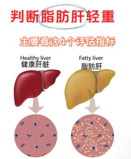 查出脂肪肝，严不严重？4个评估帮你判断病情！
1、CAP值
超声弹性报告里的“脂