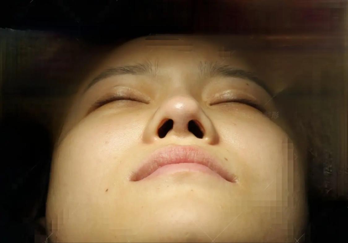 湖南长沙，一女子去隆鼻，打完麻药睡了一觉醒来，医生却告诉她，他和医美机构价格没谈