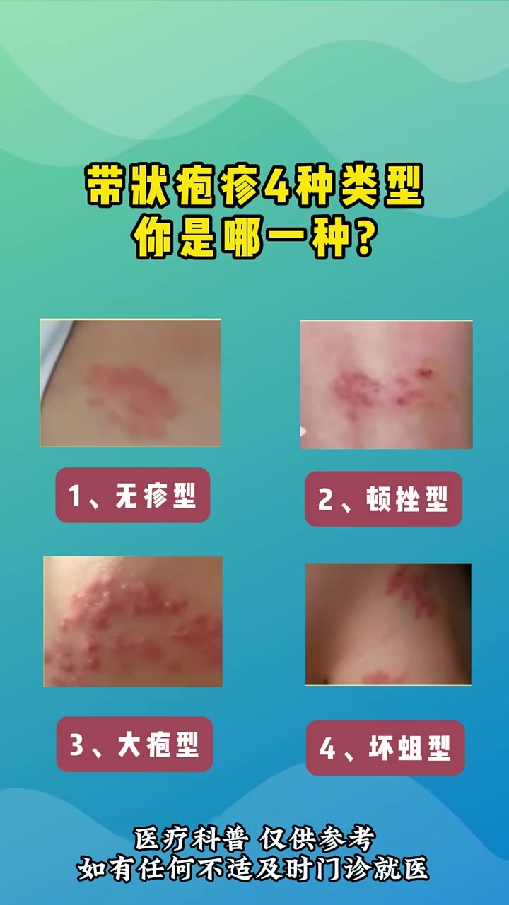 中老年已成带状疱疹高危人群90%成年人携带水痘-带状疱疹病毒，年龄越大，免疫力下