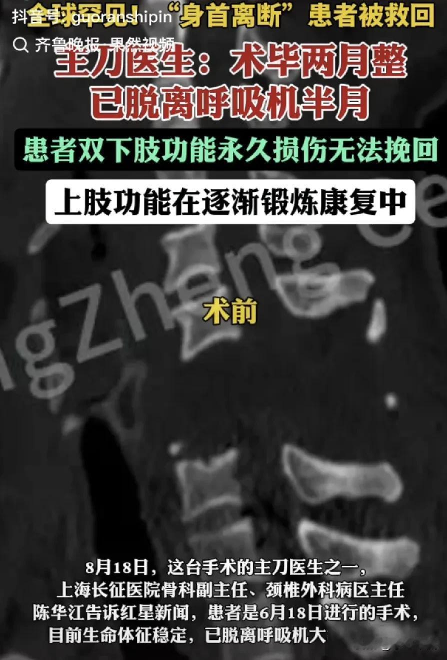 全球罕见:一名身首离断的患者手术成功，患者手术后2个月成功脱离呼吸机已经半个月，