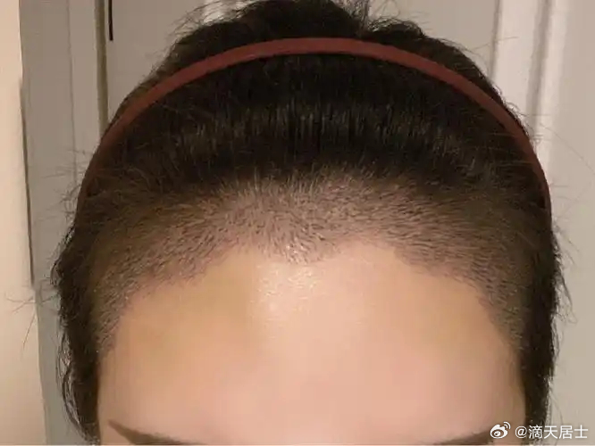 独处会更好的朋友；额头饱满，但发际线不齐的人，这样的人额头宽阔，但发际线边缘有细