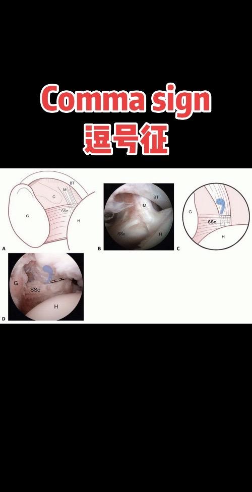 肩胛下肌腱损伤−逗号征。✅ 逗号征= 肩胛下肌肌腱断裂/撕裂的典型特征...
