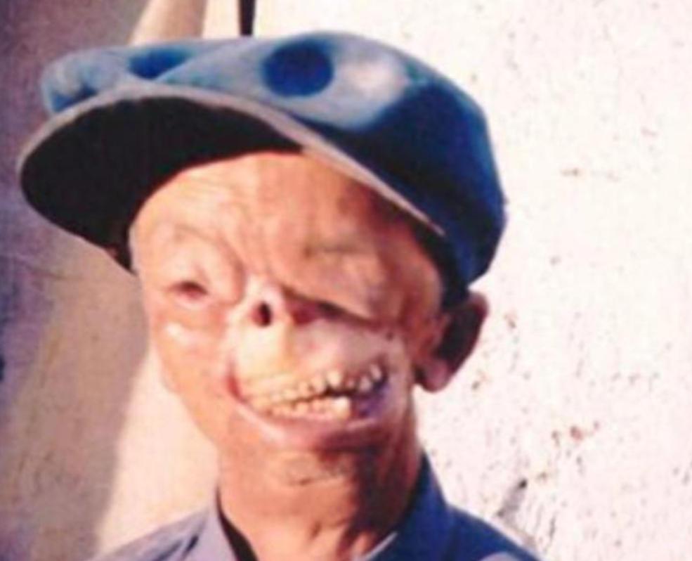 1950年，年仅3岁，就被狼咬掉了半张脸，父亲将其无情的扔到山洞中，没想到他却顽