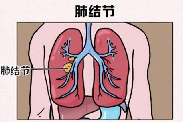 案例分享：免疫细胞清除肺部结节