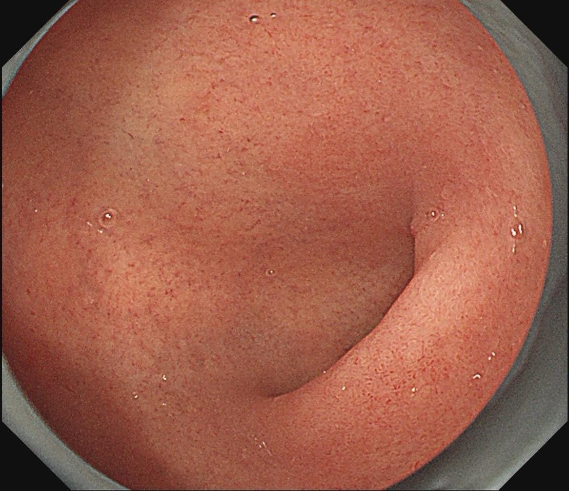 十二指肠球部NET(活检后）本来就很小，活检完白光几乎看不见……放大下...