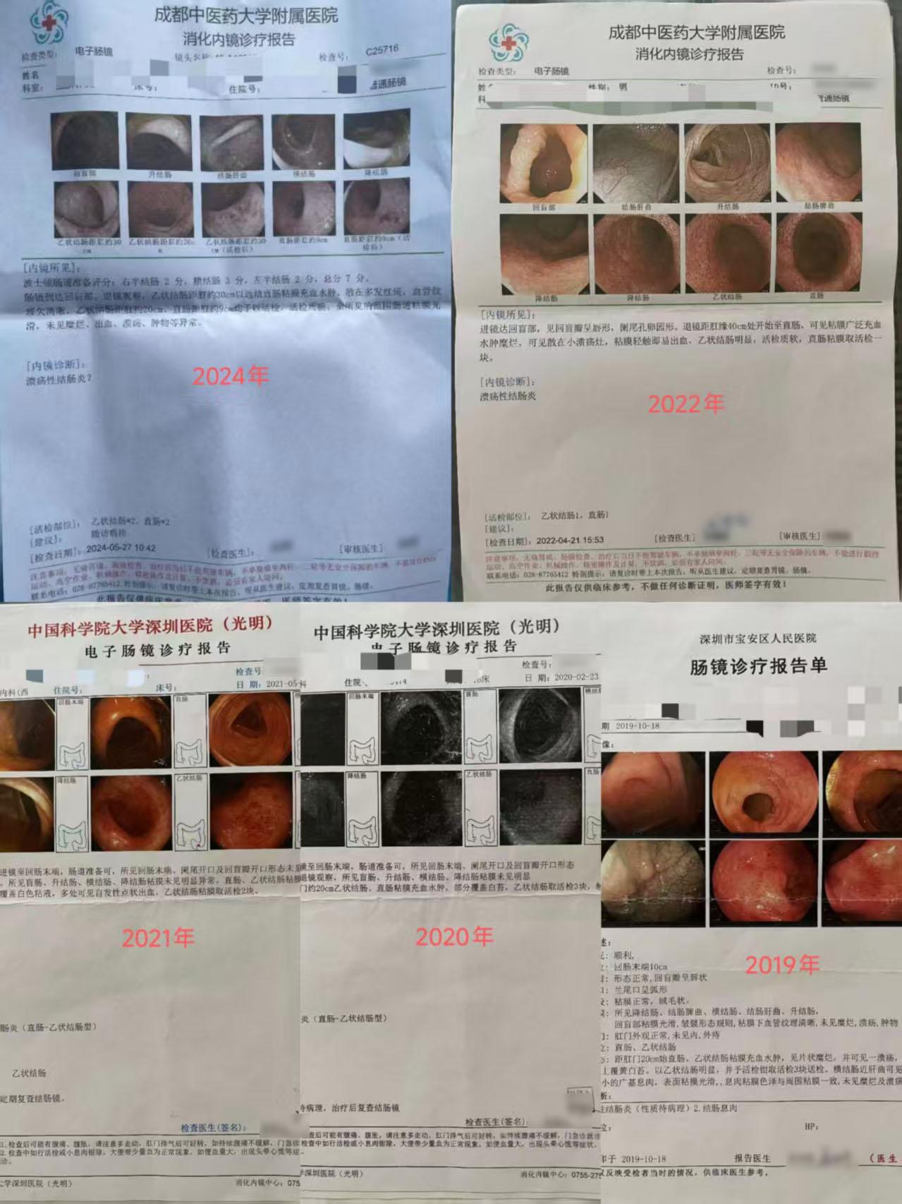 一位 14 年病史的溃疡性结肠炎患者，前 12 年在多地医院尝试多种中...