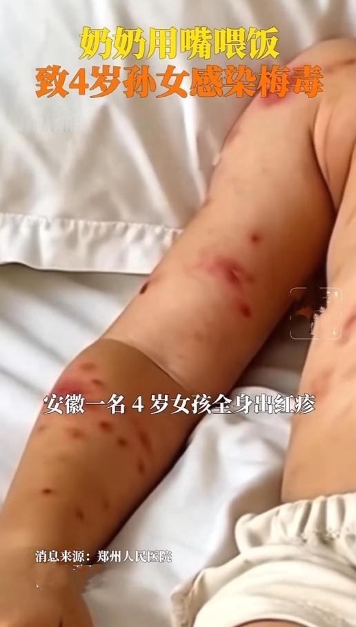 安徽这则新闻，看得家长们心都揪起来了！4岁女童全身出红疹，以为是过敏，结果查出是