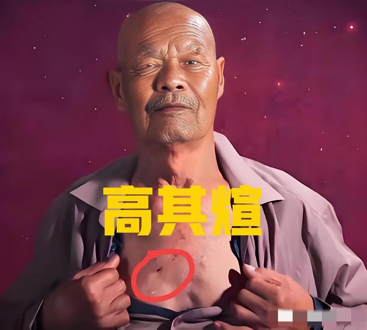 1956年，35岁的农民咳嗽10年，但却一直拒绝就医，一天，他突然用力一咳，一个