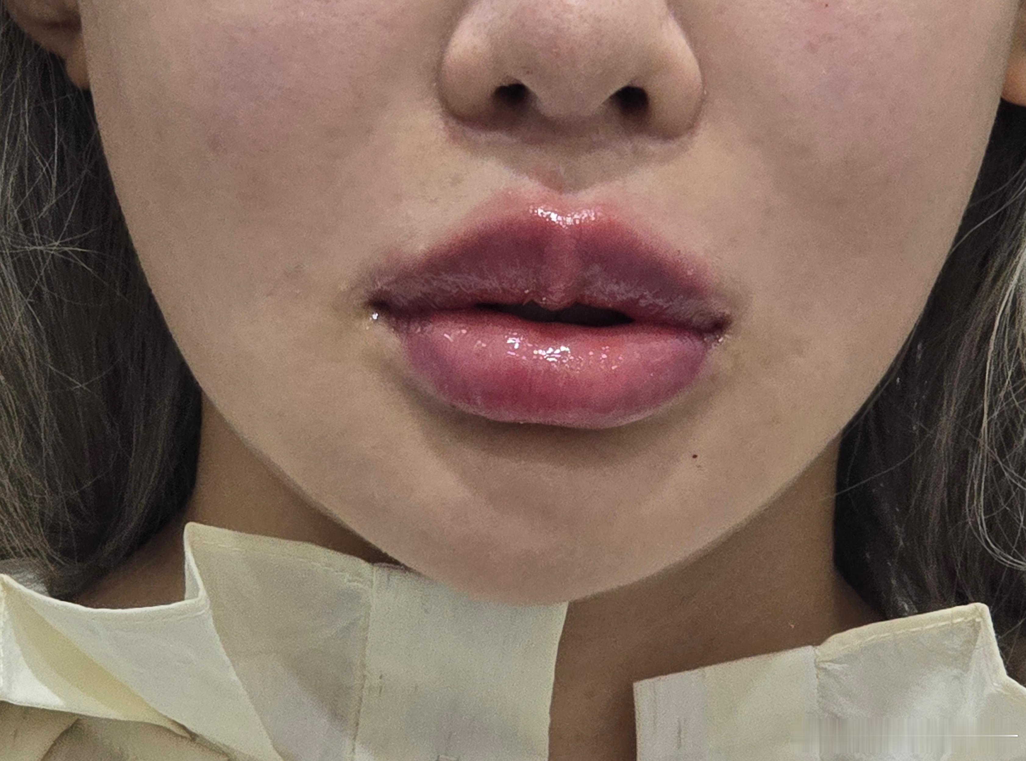 小韩打玻尿酸嘴巴之反馈：首先我感觉在哪儿打嘴巴都消的很快，也可能是刚打完特别肿，