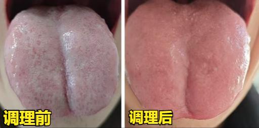 舌诊才是最能直白反映你身体健康的方式，明显可以看出身体前后的一个变化！
 
调理