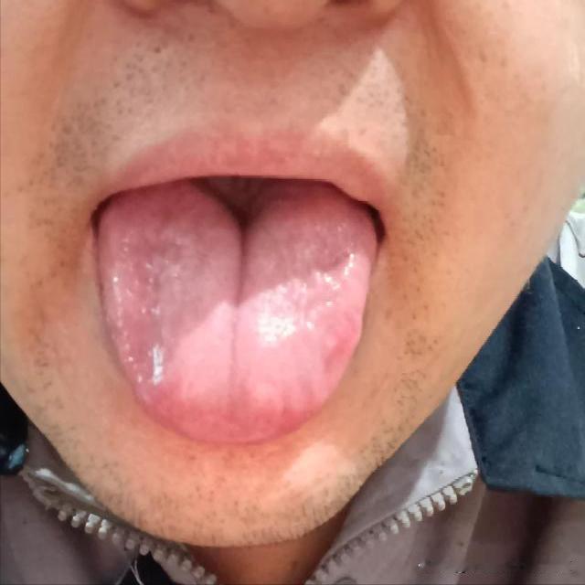 粉丝大哥总感到浑身无力，吃不下饭，情绪老是不稳定[惊呆][惊呆]
你这舌根凹的都